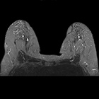 乳腺の精密検査の為の高分解能撮影