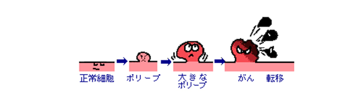 大腸がんの成長過程