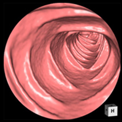 大腸ＣＴ検査（ＣＴ colonography：ＣＴＣ）