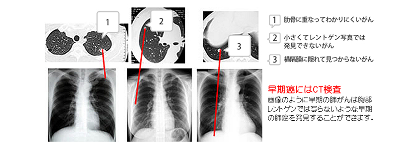 胸部ＣＴ検査