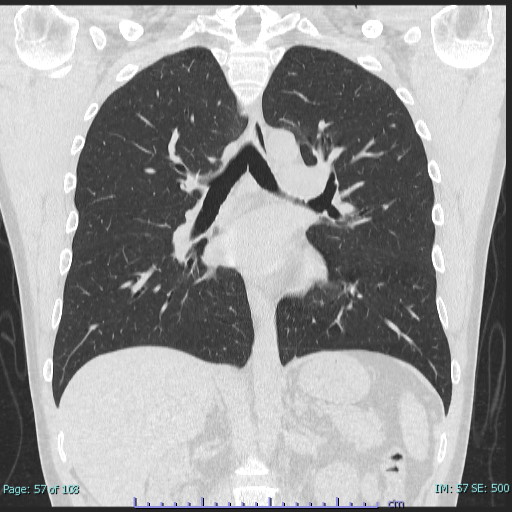 胸部CT_冠状断像