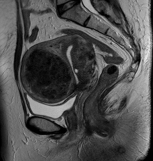 骨盤部MRI_女性