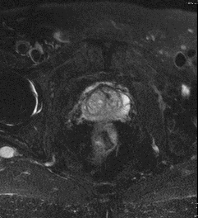 骨盤部MRI_男性