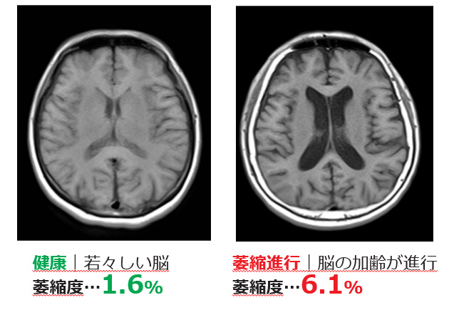 脳の健康管理